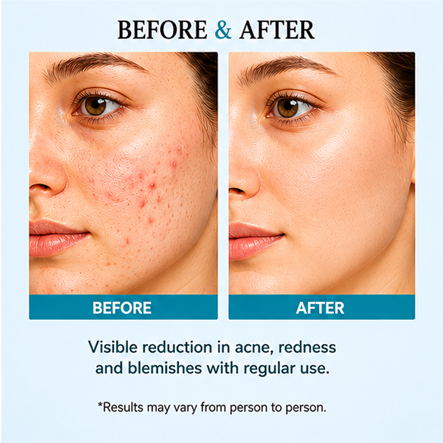 zalore™ anti-acne clarifying serum | blemish care & smooth skin support | 30ml