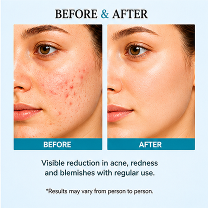ZALORE™ Anti-Acne Clarifying Serum | Blemish Care & Smooth Skin Support | 30ml